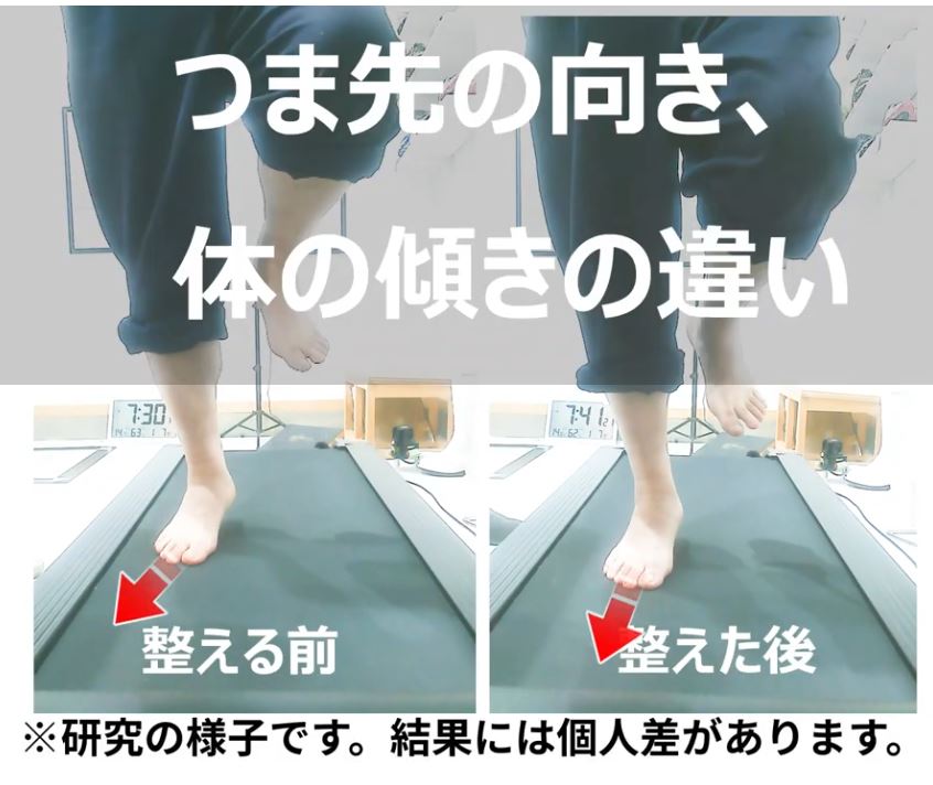 足底腱膜炎の原因になるつま先の向きの説明