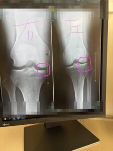 X脚と外側半月板逸脱のご相談について 膝のレントゲン写真:変形性膝関節症の疑い
