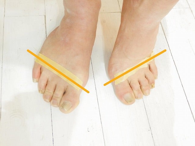 つま先が外を向く原因と歩き方
