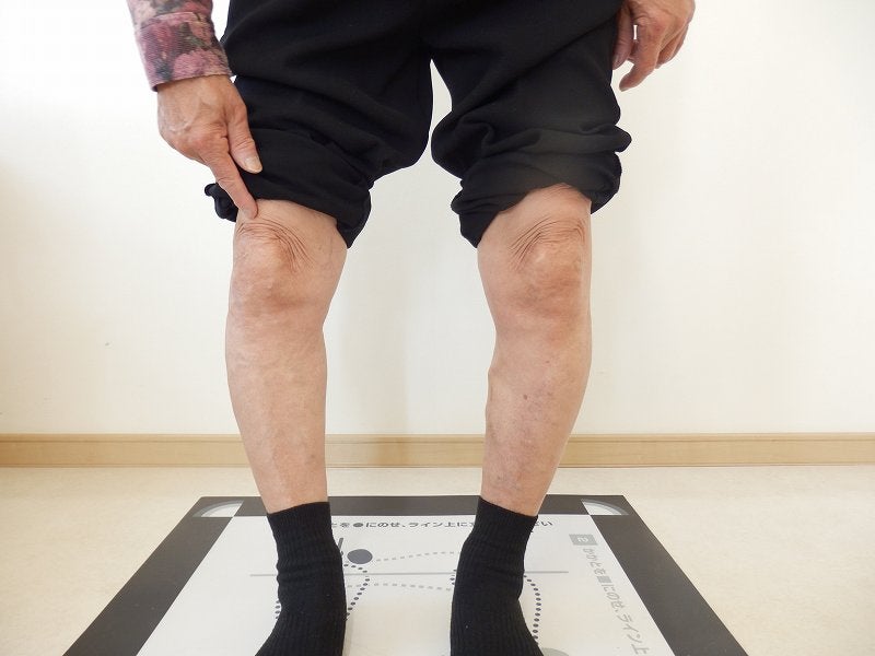 膝の痛みの原因、X脚、半月板逸脱