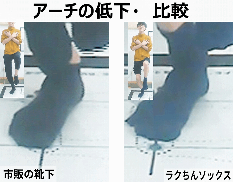 つま先が外を向く理由:アーチ低下比較