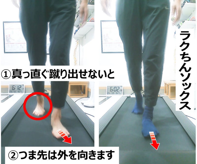つま先が外を向く、トゥアウトの画像