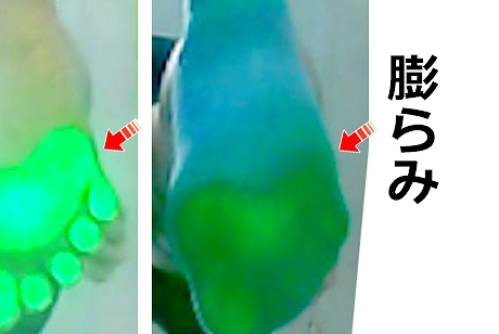 その結果、
MP関節の収縮（締め付け）力が不十分となり、
足部外側縦アーチおよび水平アーチの形成が妨げられていることが明らかである。