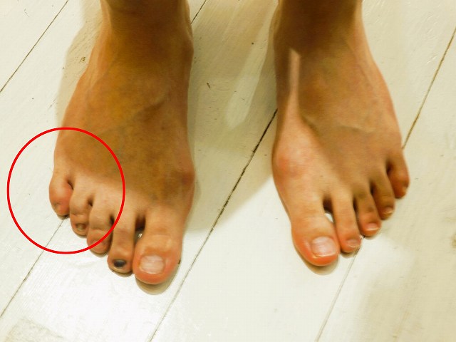 足の小指の内反小趾・寝指の状態
