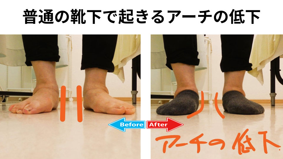 靴下を履くと扁平足になった画像