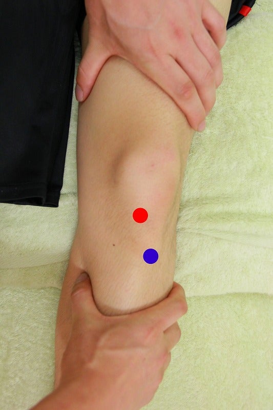 膝のオスグッド病、治療前の膝蓋骨下隆起