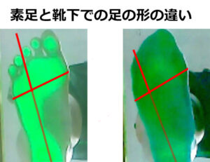 靴下を着用することで、足の形、特に外側アーチのラインが変化していることを表している画像。このことにより、足のタコ、魚の目、マメ、歩き方のクセの原因になる。