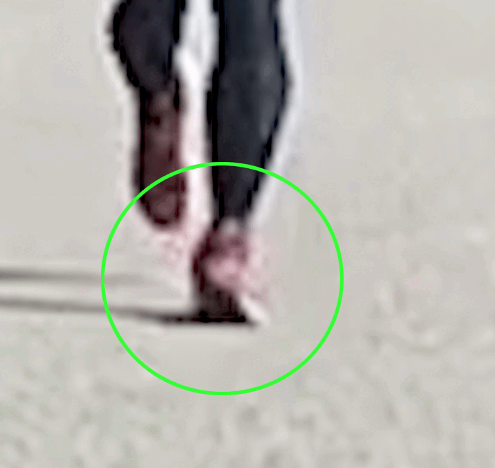 足のアーチ崩壊、外側支持の喪失