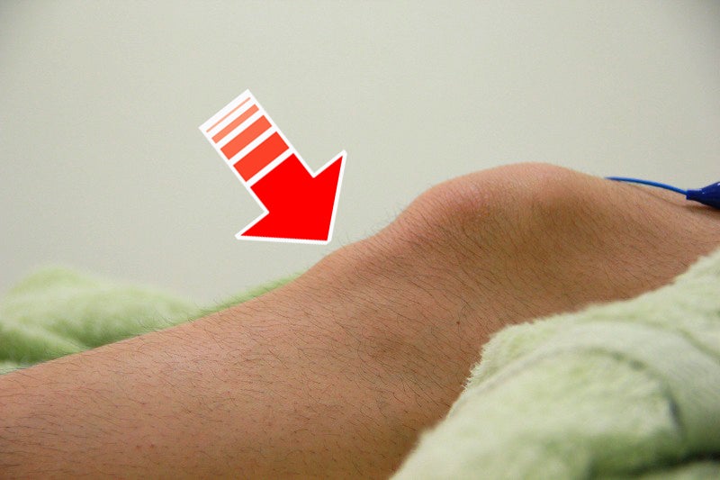 膝の痛み、オスグッド、膝蓋骨下盛り上がり