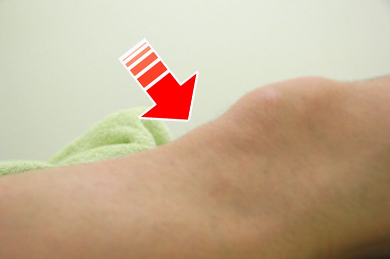 オスグッド病の膝、盛り上がりを赤矢印で示す