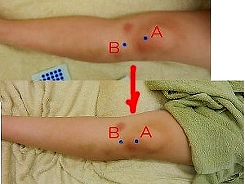 膝のオスグッド治療前後の画像