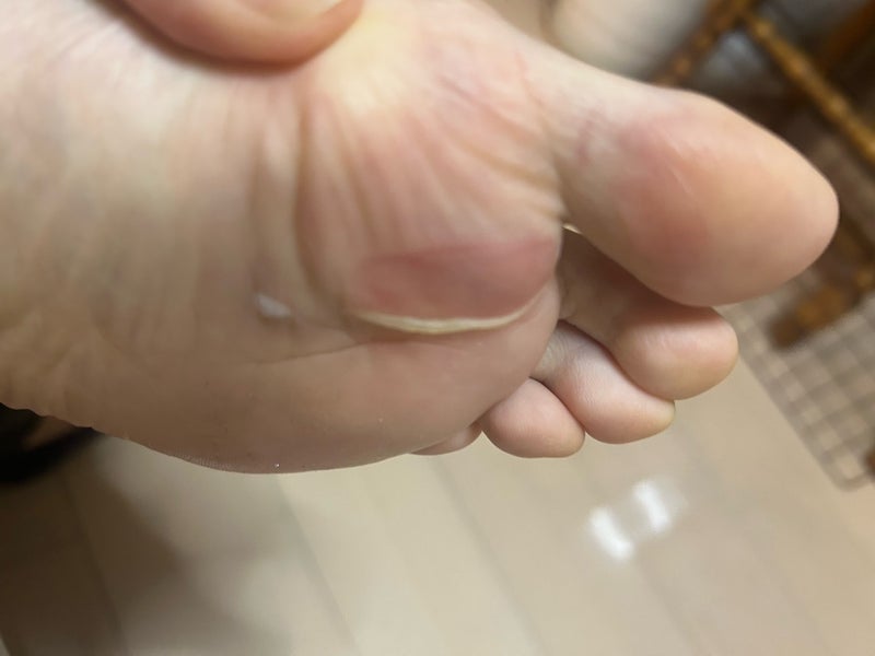外反母趾の人は特に足の裏に大きなマメができやすくなります。