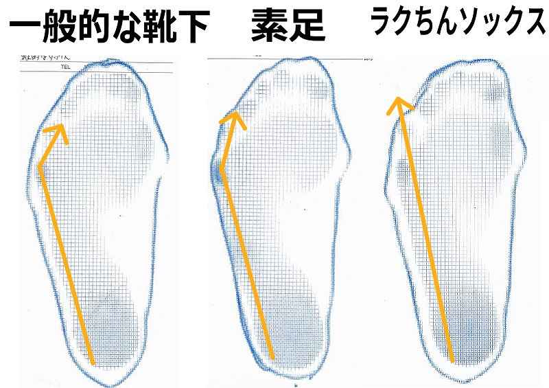内反小趾が改善している様子