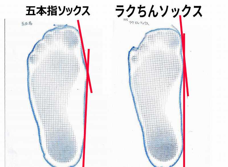 五本指ソックスとラクちんソックスの違いを示す、指幅と足幅の比較画像（フットプリント）ラクちんソックスの方が、五本指ソックスより外反母趾の外半角が改善している様子。