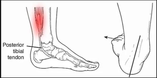 ランニング・陸上競技の後脛骨筋炎の原因