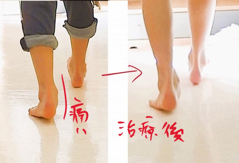 有痛性外脛骨　歩き方