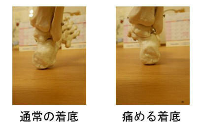 概要:踵骨骨端症(シーバー病)とは