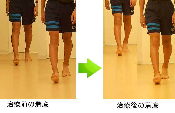 概要:踵骨骨端症(シーバー病)とは