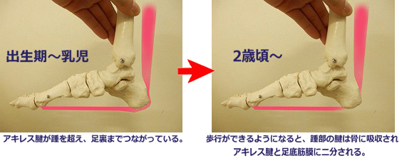 概要:踵骨骨端症(シーバー病)とは
