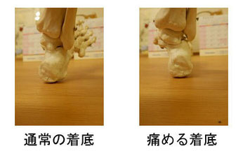 概要:踵骨骨端症(シーバー病)とは