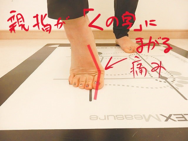 親指の付け根に負担が集中し痛みが出やすい足部の状態